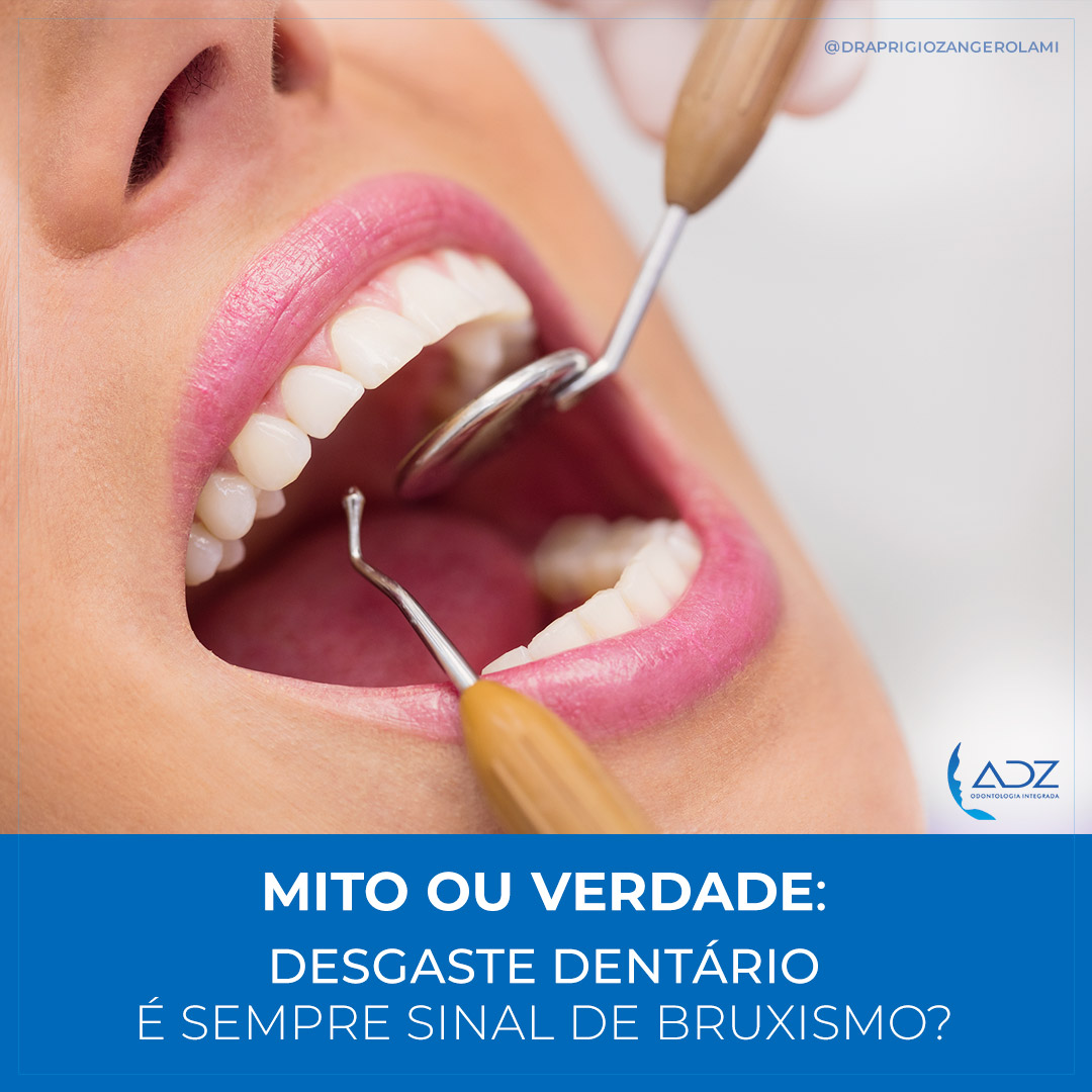 Mito ou verdade: Desgaste dentário é sempre sinal de bruxismo?