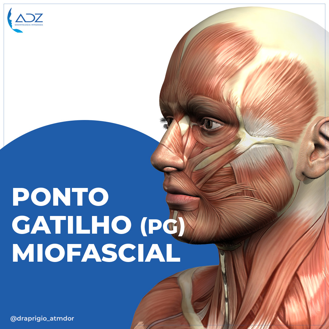 Ponto Gatilho (PG) Miofascial